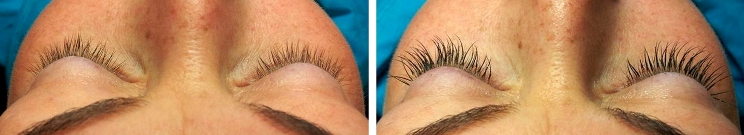 Eyelash Extensions Before and After